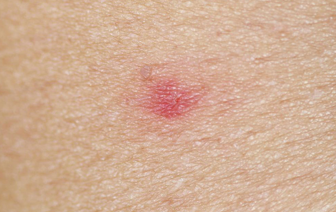 How to identify a bug bite